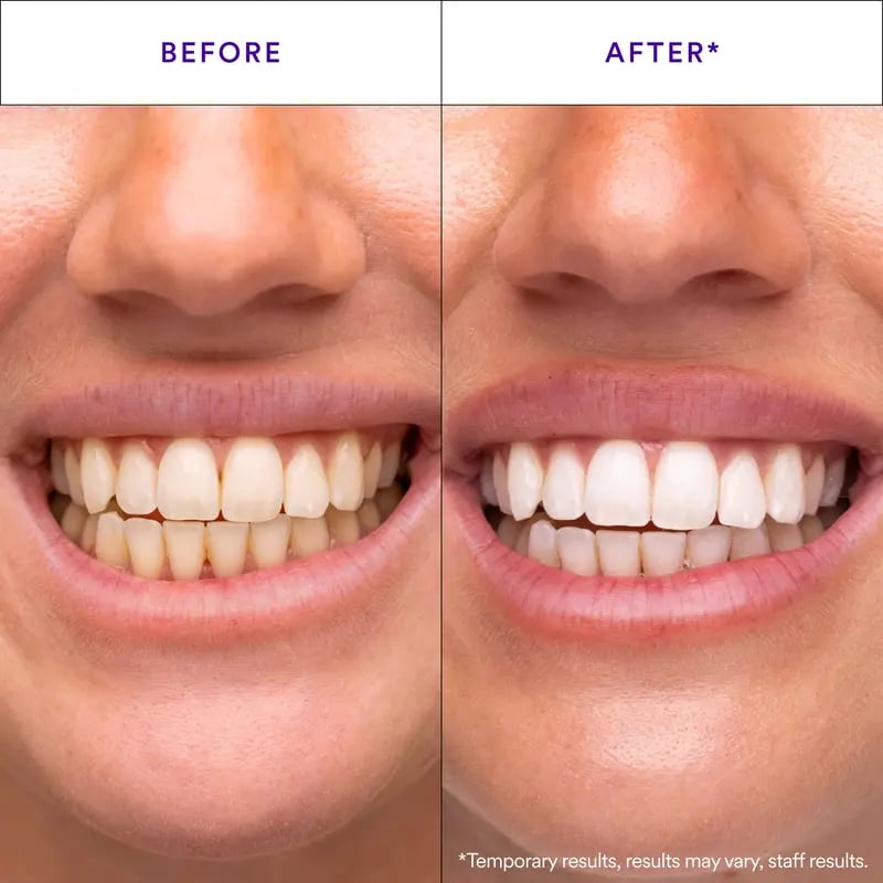 Hismile V34 Whitening Strips