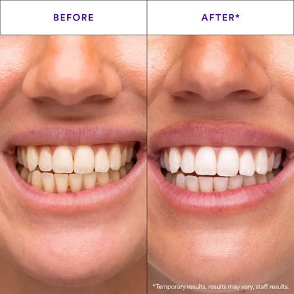 Hismile V34 Whitening Strips